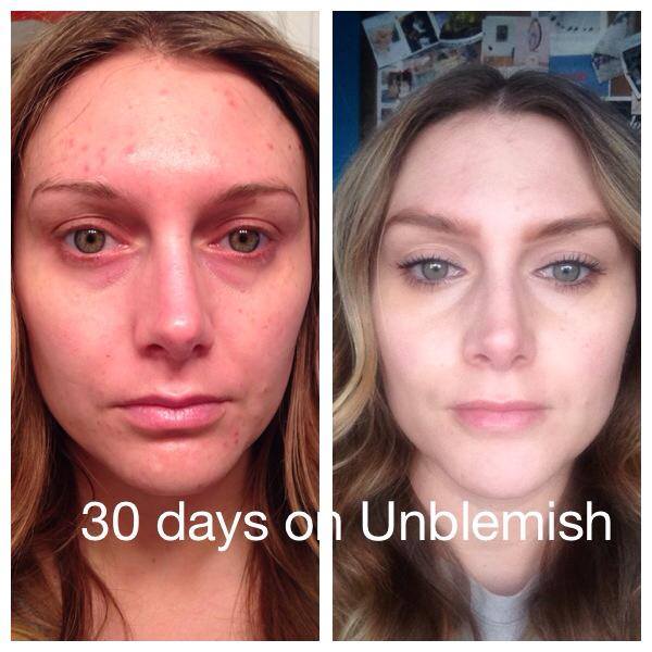 Skin before after acne care and for artistry websites xenia haband